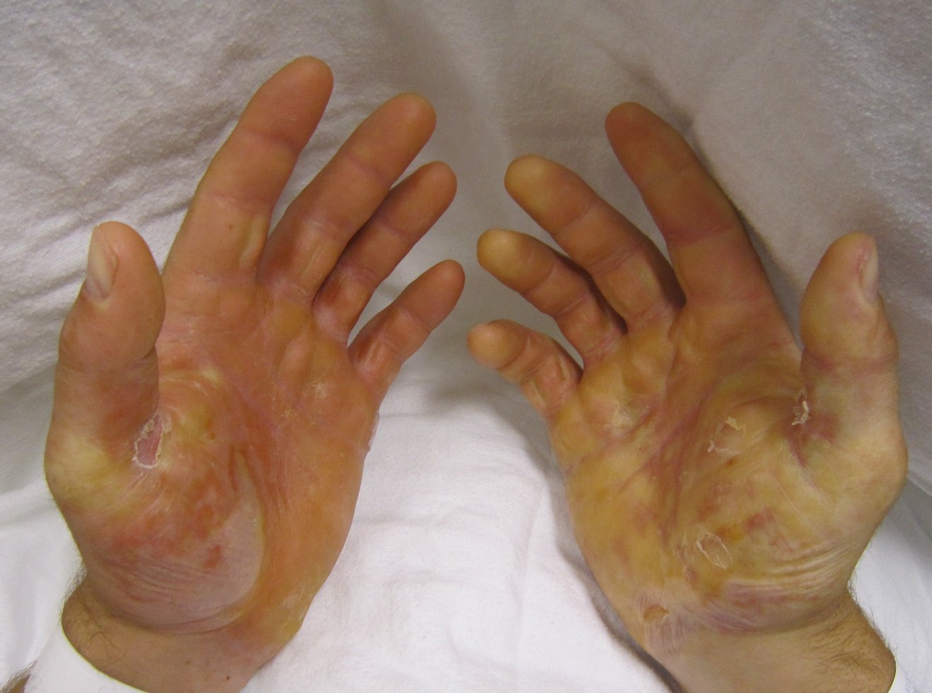 Epidermolysis bullosa 1