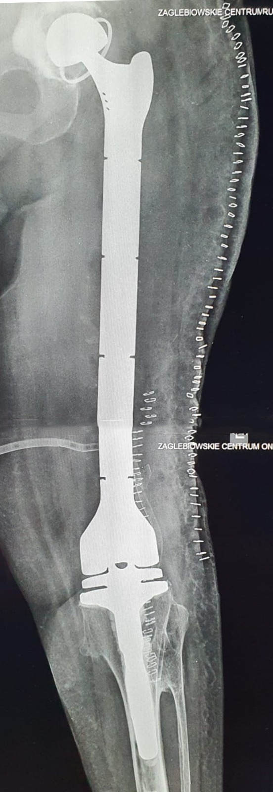 Operacja total femur