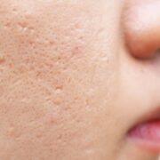 Blizny po trądziku na twarzy