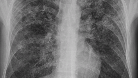 Pulmonary TBCXR