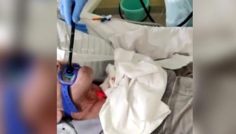 Csm Szpital Slaski proteza glosowa 1 21dba25c4f