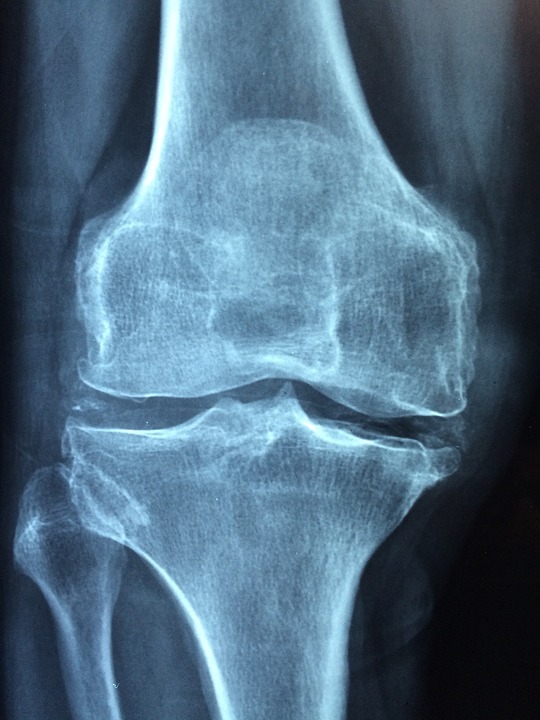 Knee 1406964 960 720